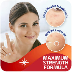 Close-up of acne blemish treated with Asepxia.