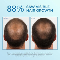 BosleyMD Minoxidil Spray Aplicación precisa evita goteos y mejora la distribución.