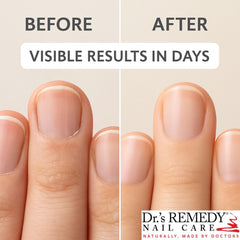 Dr.'s Remedy masaje suave para cutículas secas