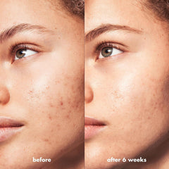 e.l.f. SKIN Blemish Breakthrough: complejo ácido triple.