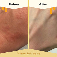 ECZEMA HONEY aloe: calma la piel con aloe vera.