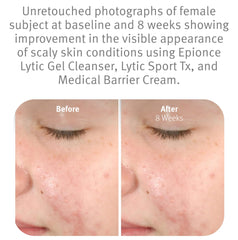 Enjuague del Epionce Lytic Gel Cleanser con agua templada