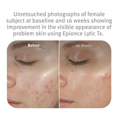 Epionce Lytic Plus Tx, aplicación diaria para piel equilibrada.