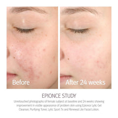 Epionce Renewal Lite Loción Facial: absorción rápida para piel mixta.