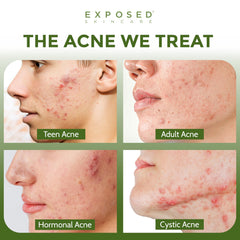 Exposed Skin Care kit: limpieza de poros para poros más finos.