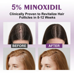 EZBIORT minoxidil spray being applied to thinning scalp areas.