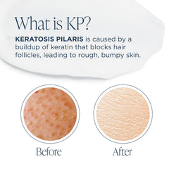 Glytone KP Kit: Esponja de ducha para exfoliar suavemente.