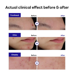 Textura hidrocoloide de Mediheal Derma Clear que absorbe el exudado
