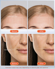 NEWKEY máscara luz facial, opción de 10 minutos con apagado automático para comodidad
