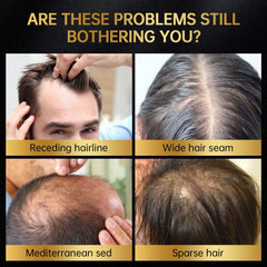 OCSINL Minoxidil gotero preciso para llegar a las raíces y estimular el crecimiento.