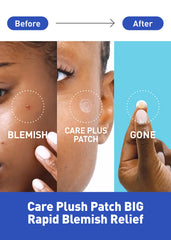 OLIVE YOUNG Care Plus Spot Patch aplicado en la piel, cobertura rápida y discreta.