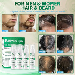 ONIADBA Minoxidil en cuero cabelludo para estimular crecimiento capilar.