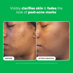 Paula's Choice BOOST 10% ácido azelaico, serum-sin-fragrancia: piel sensible cuida.