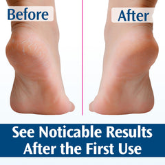 Callos suaves con PediFix en el pie, piel más uniforme