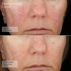 Aplicación de Senté Dermal Repair con dedos para rostro y cuello