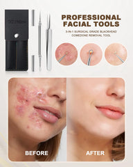 Aguja de titanio con aro circular de SGNEKOO para extracción precisa.