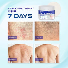 TAGRID Folliculitis Cream jar and packaging highlighting product details.