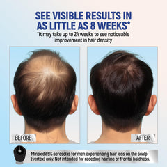 TARO Minoxidil espuma: penetración rápida mejora cobertura capilar.