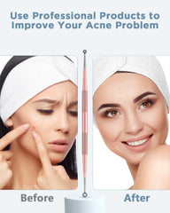 TAYTHI extractor de acné para el rostro facilita extracción cuidadosa de comedones