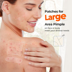 Parches hidrocoloides TKTK 8 mm para imperfecciones pequeñas.