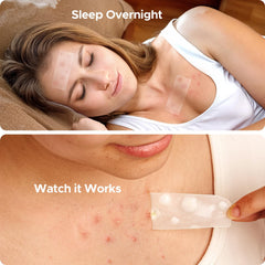 Parche TKTK para acne en el pecho, solución discreta para áreas amplias.