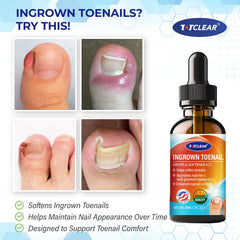 TOTCLEAR gotas correctoras para uñas, mejora la apariencia