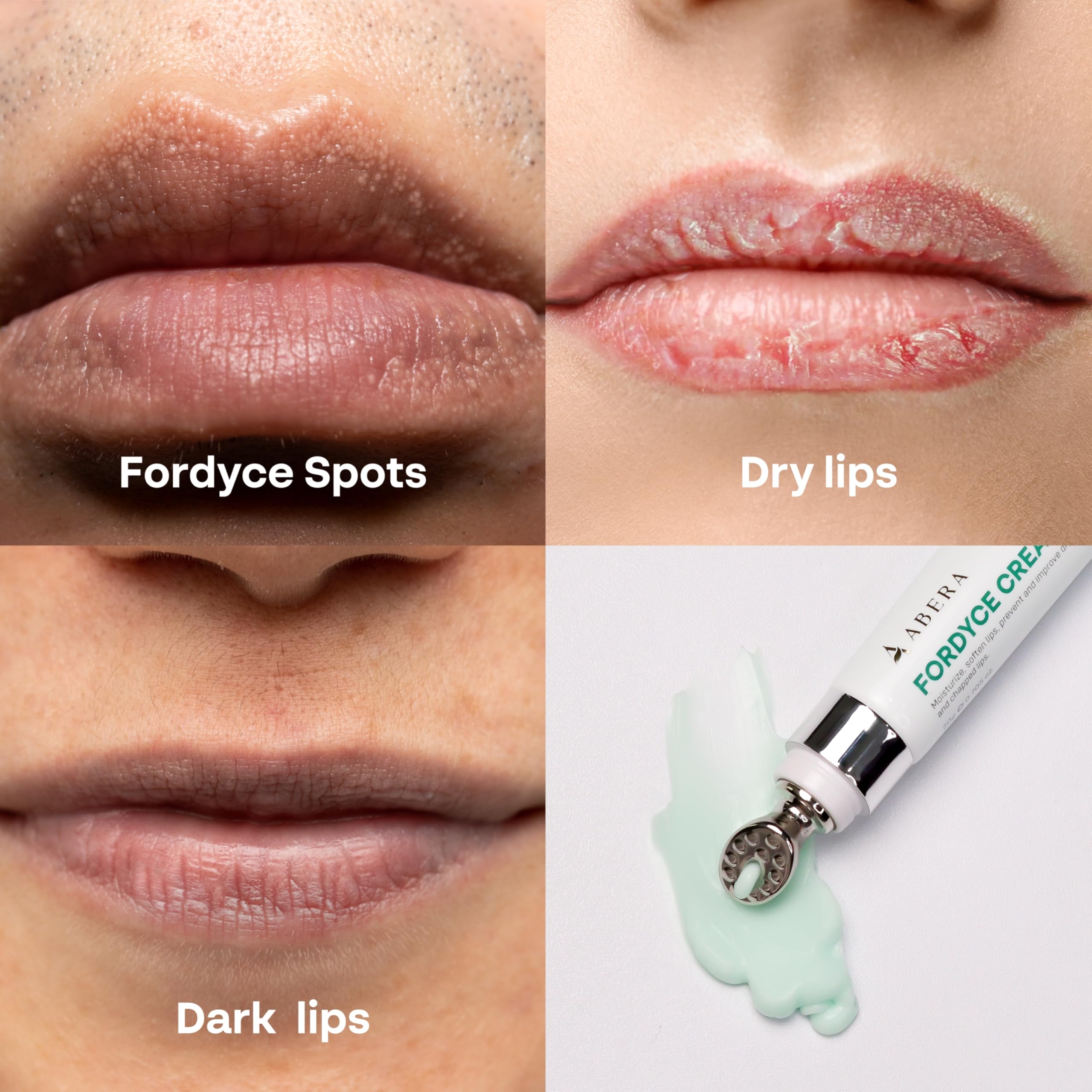 Abera Fordyce, uso suave en labios y zonas sensibles