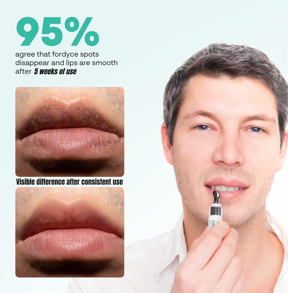 La crema Abera Fordyce nutre labios con manteca de karité y aceite de almendra