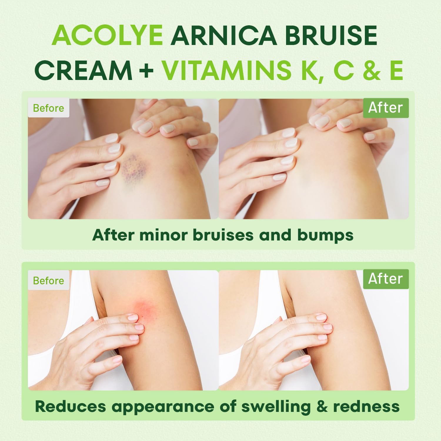 Enfoque en áreas sensibles con Acolye Arnica para una piel calmada.