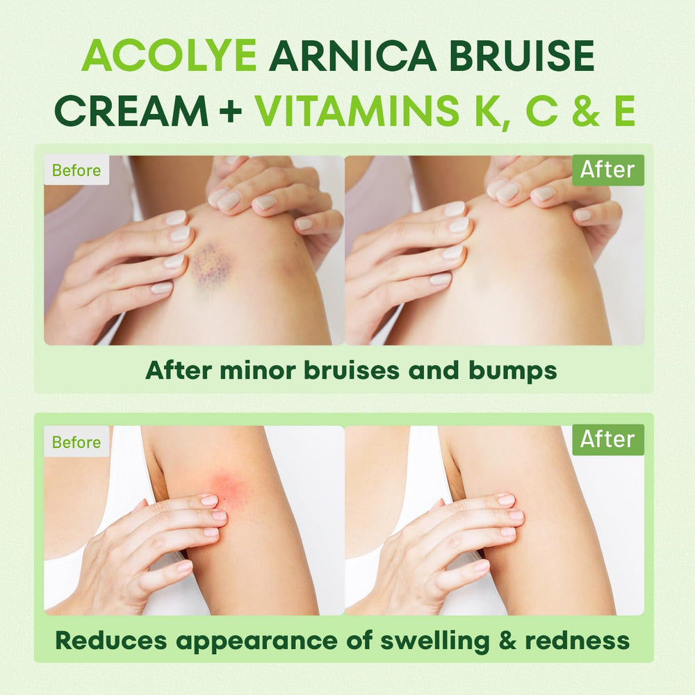 Enfoque en áreas sensibles con Acolye Arnica para una piel calmada.