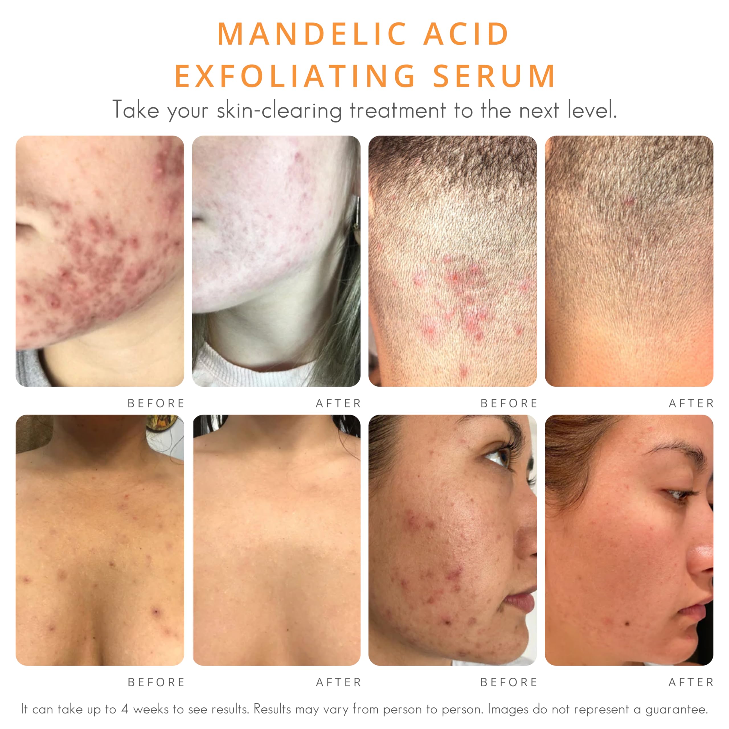 Application du sérum Almond Clear sur le visage pour purifier les pores.