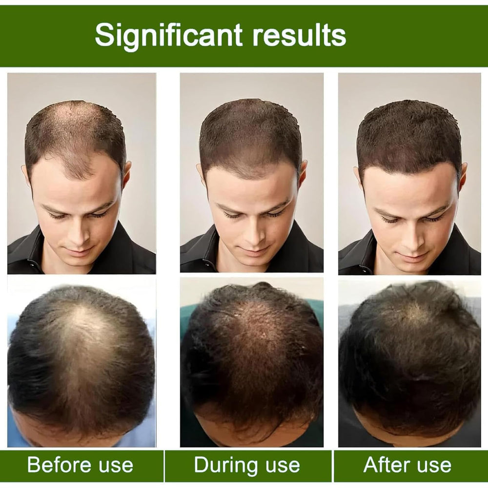 Alphainfuze-kit-densité-cheveux: soutien pour cheveux plus épais.