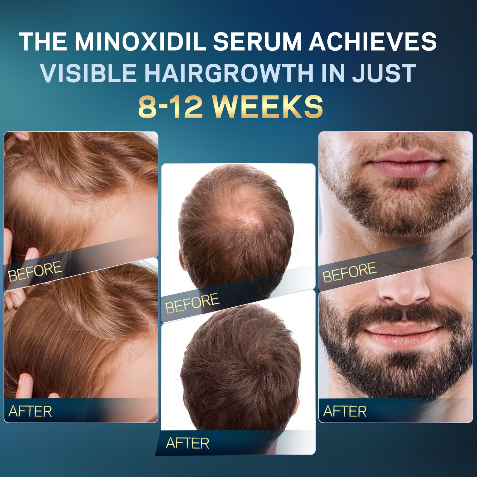 AMOADO Minoxidil Serum aplicación en cuero cabelludo para cuidado diario