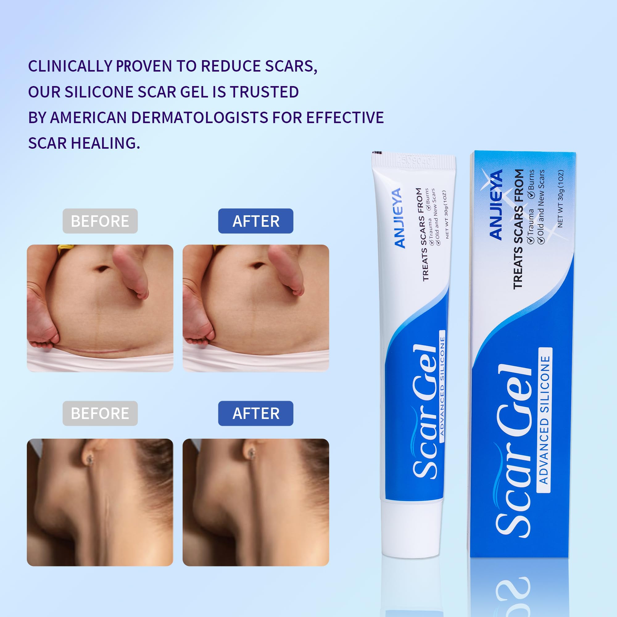 ANJIEYA gel de cicatrices silicona, uso diario para piel sensible y segura.