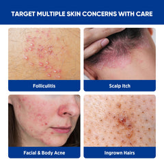 AOSORW crema foliculitis en la cara para suavidad diaria