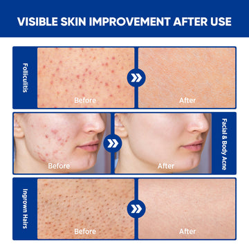 AOSORW crema foliculitis aplicada en el cuerpo para confort