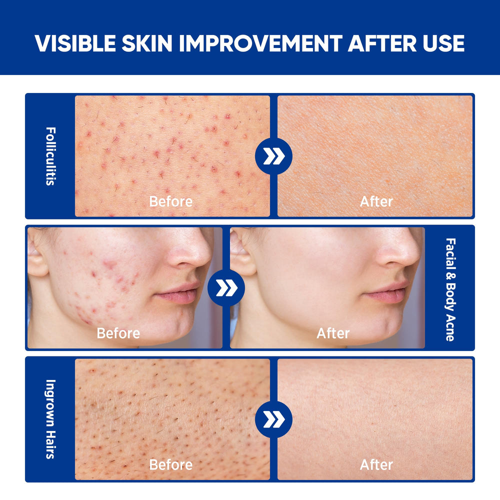 AOSORW crema foliculitis aplicada en el cuerpo para confort