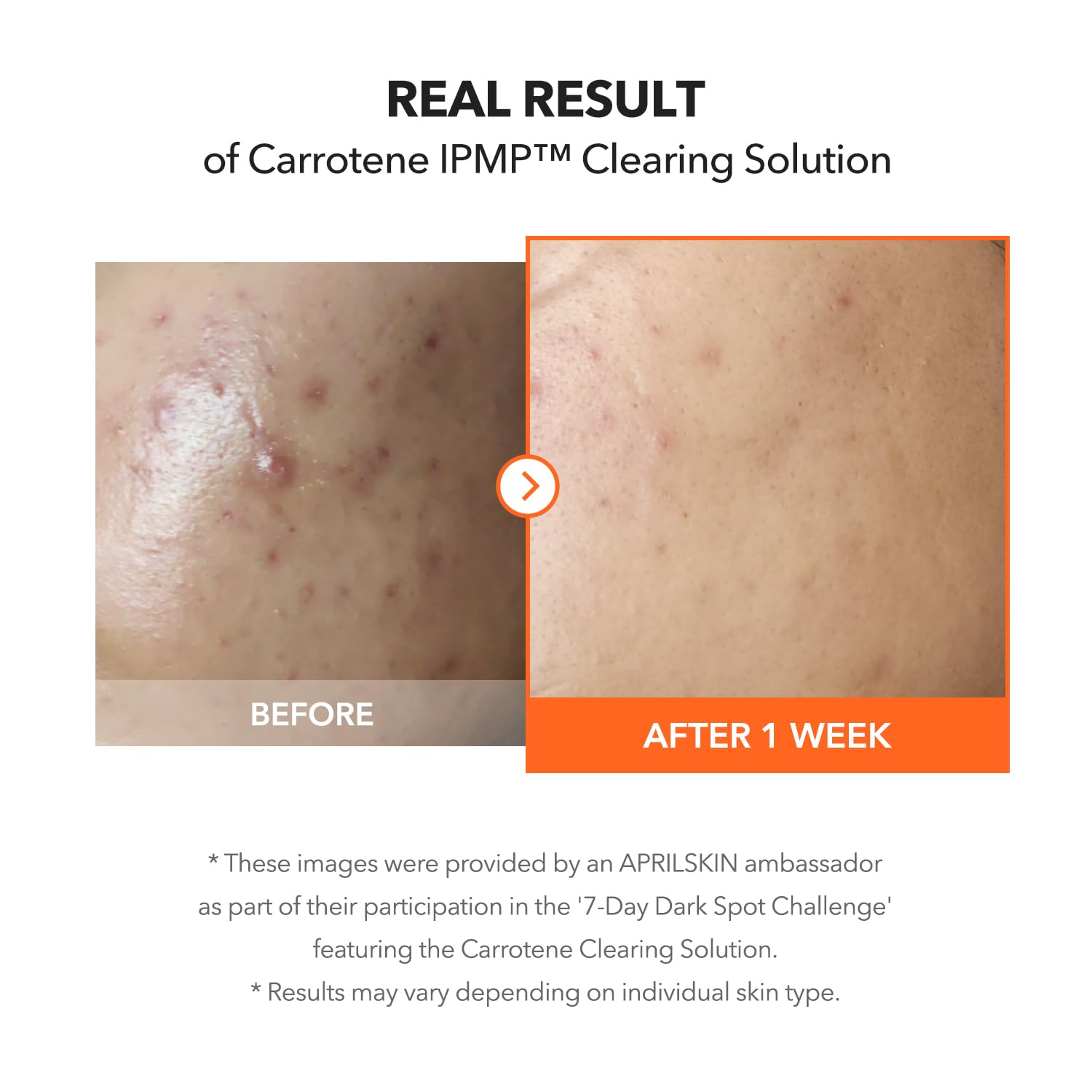 APRILSKIN Carrotene IPMP: niacinamida 5% regula el sebo.