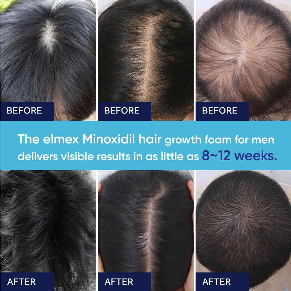 Espuma con colágeno hidrolizado, soporte capilar con Artimore Minoxidil 5%.
