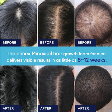 Uso para barba y cabello femenino con Artimore para mayor densidad