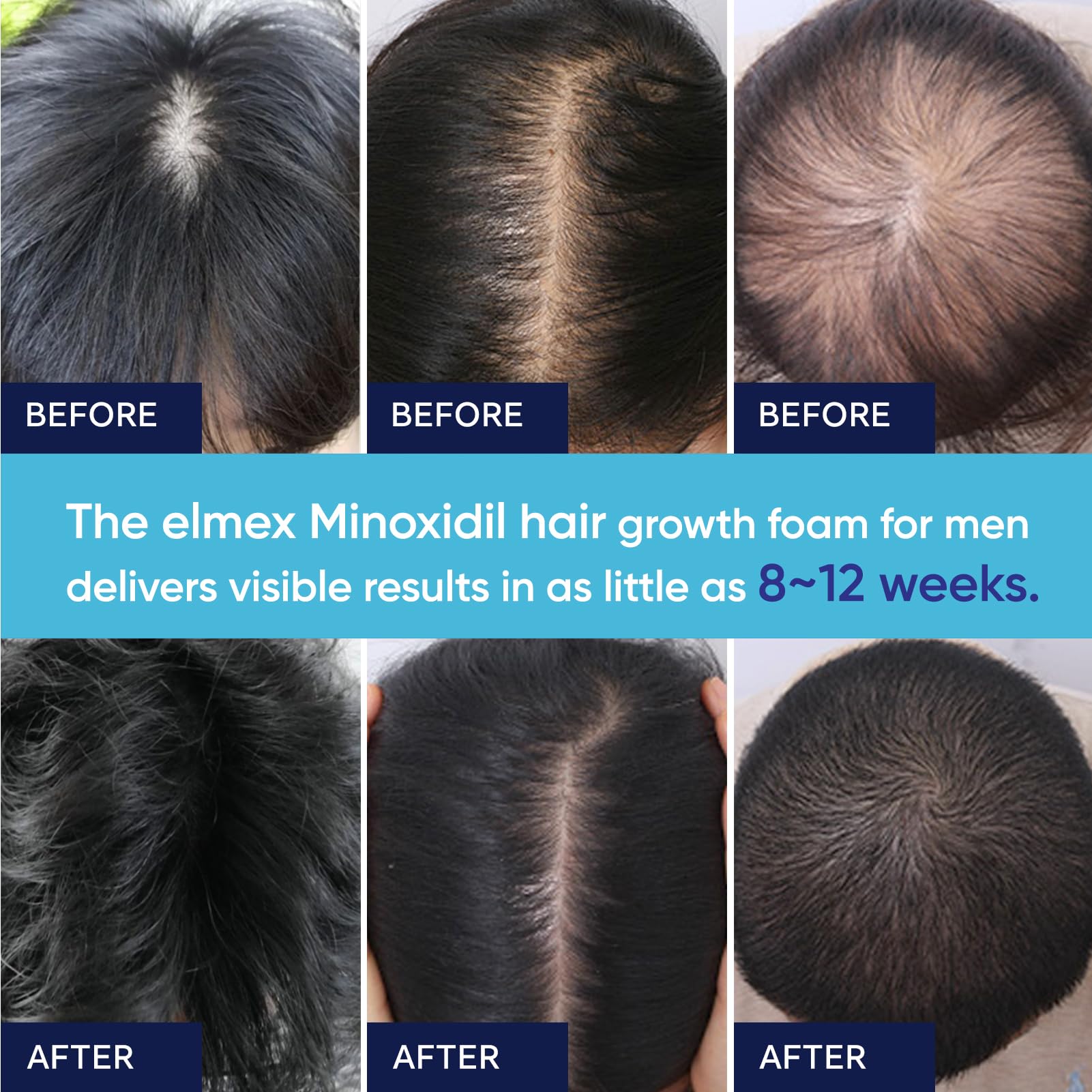 Artimore Minoxidil Mousse 5% — convient aussi pour la barbe et les poils du visage