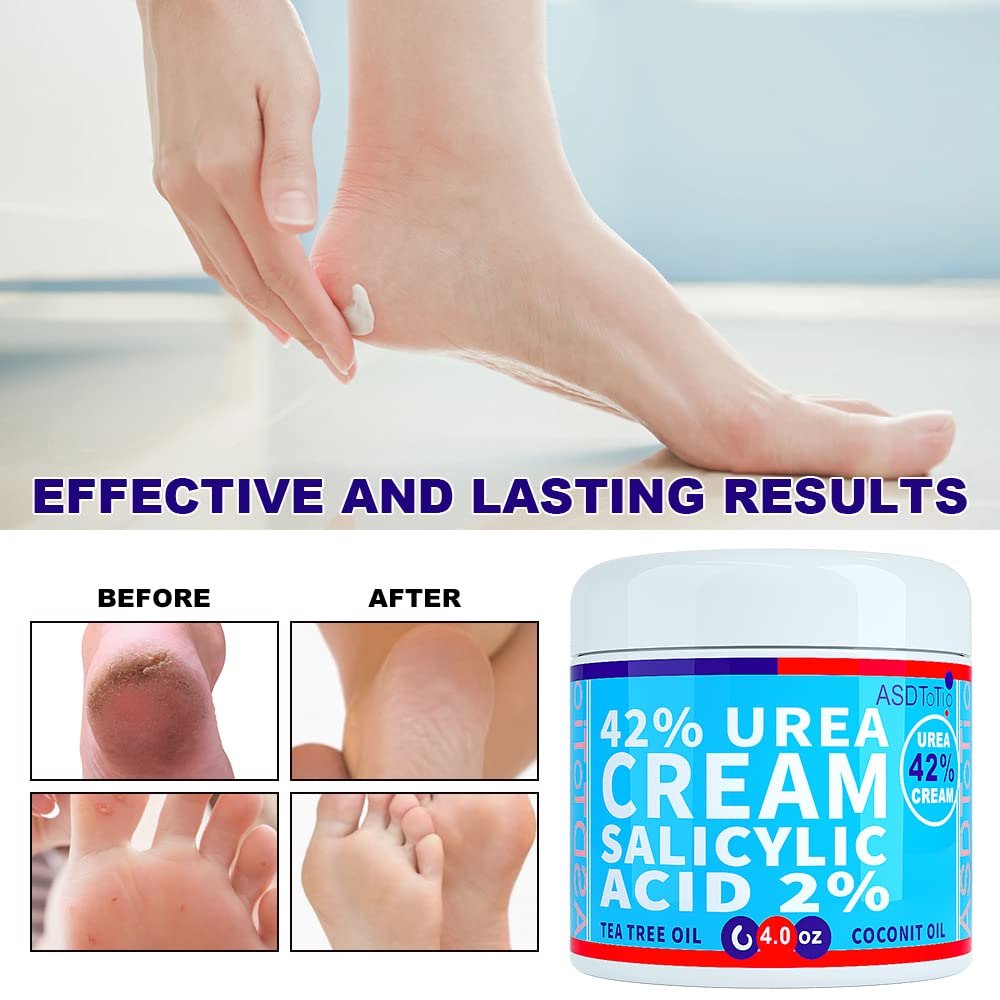ASDToTio Urea 42% crema con aloe vera: calma la piel de pies y manos.