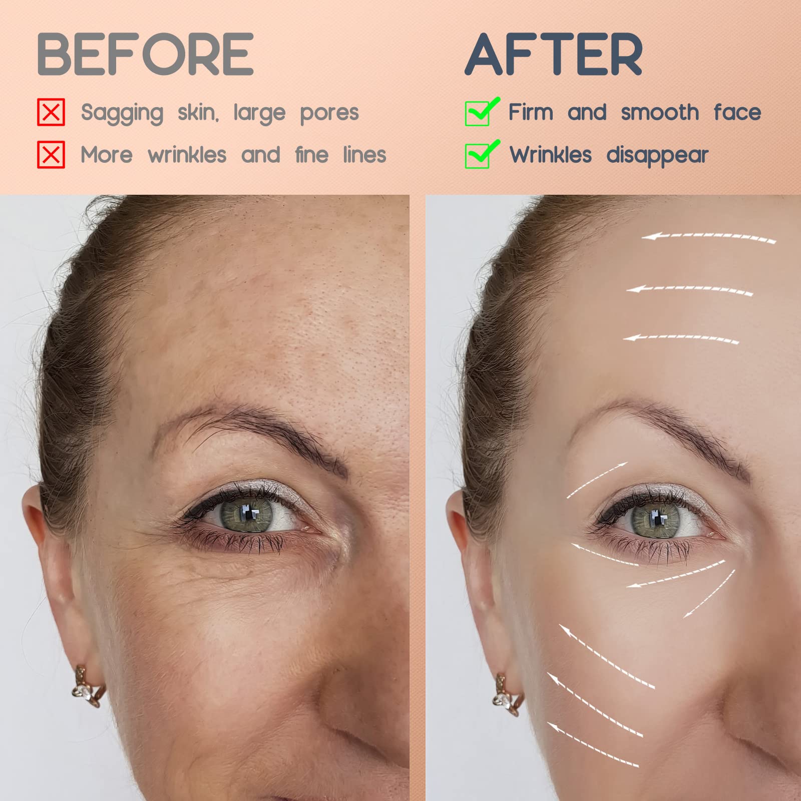 Efecto suave de lifting en piel sensible