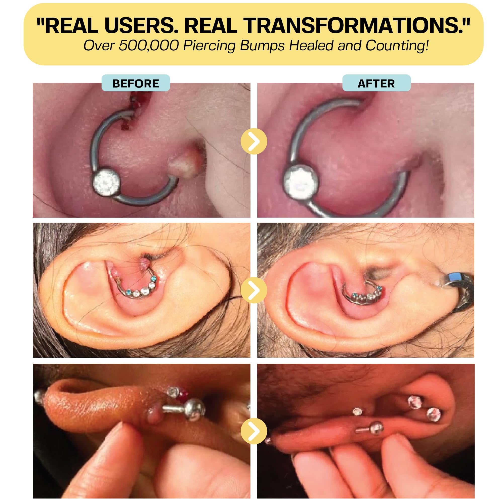 BASE LABORATORIES Keloid Bump Removal Gel para orejas y otras áreas