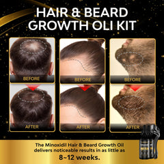 Beaueli Minoxidil 5% se aplica en la barba para un aspecto lleno.