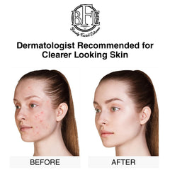Beauty Facial Extreme Acne Pads eliminan puntos negros y rojeces leves
