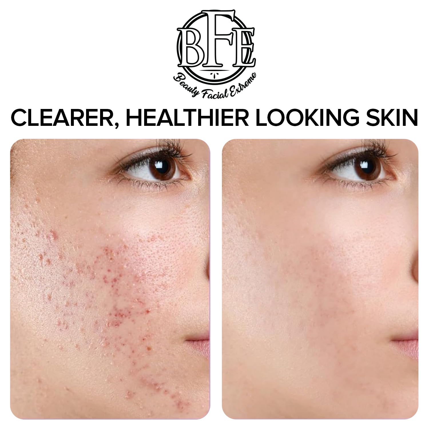Beauty Facial Extreme Acne Pads fórmula con ácido salicílico y AHA