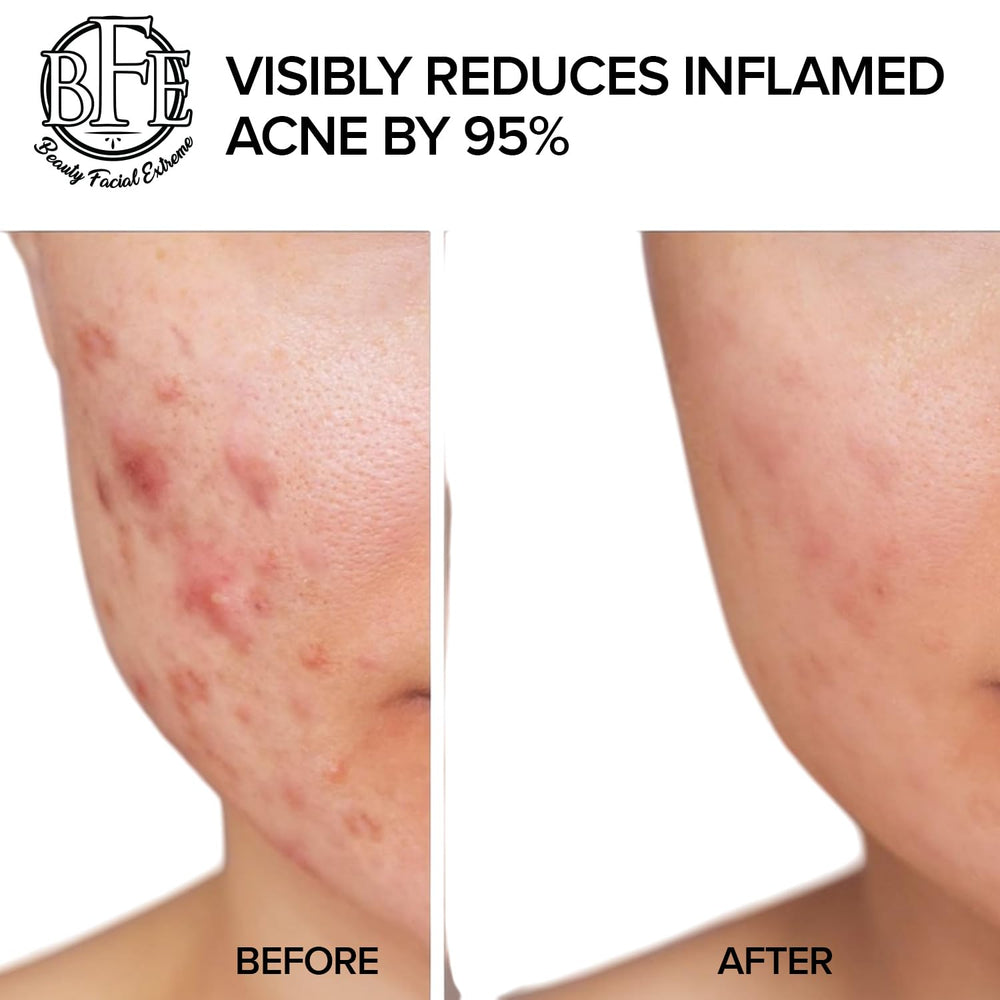 Beauty Facial Extreme Acne Pads sensación refrescante tras la aplicación
