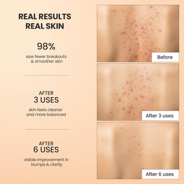 BellamiLuxx exfoliante cuerpo acne aplicación manual en ducha