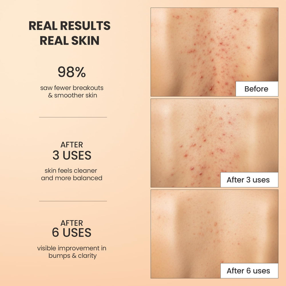 BellamiLuxx exfoliante cuerpo acne aplicación manual en ducha